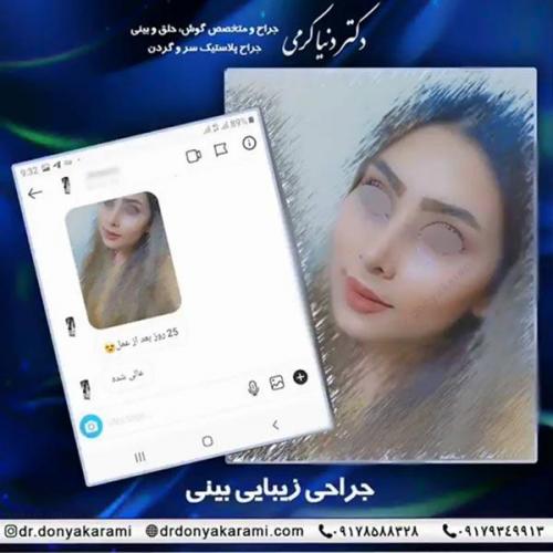 جراحی-بینی-41