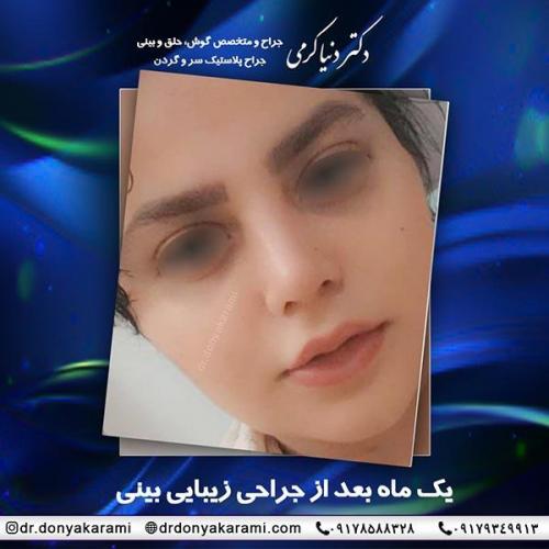 جراحی-بینی-42