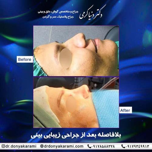 جراحی-بینی-43