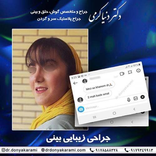 جراحی-بینی-44