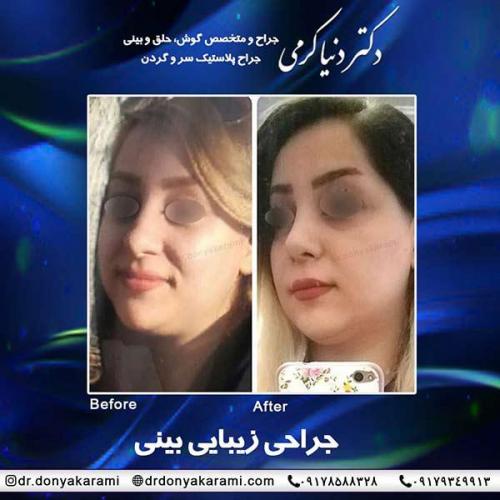 جراحی-بینی-48