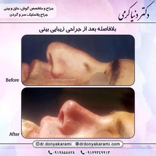 جراحی-بینی-5