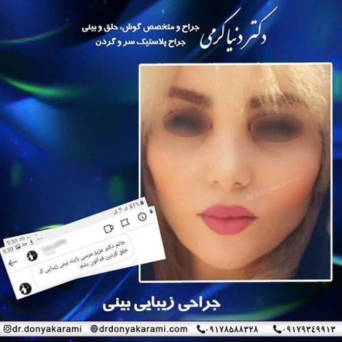 جراحی-بینی-50