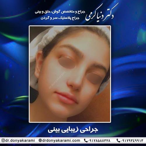 جراحی-بینی-56