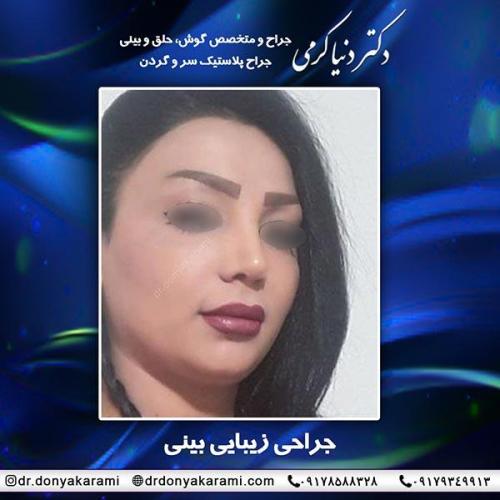 جراحی-بینی-57