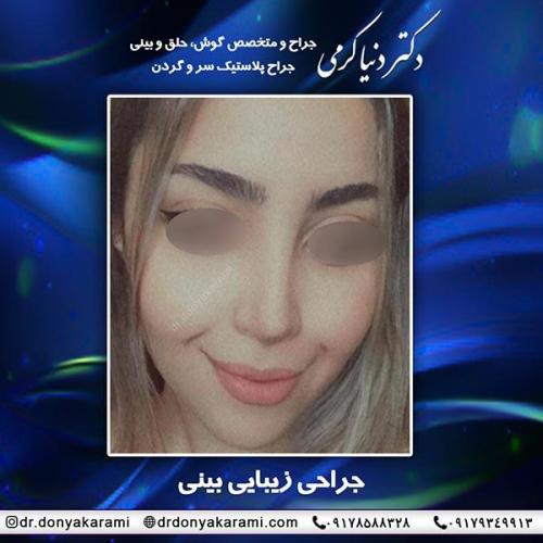 جراحی-بینی-58