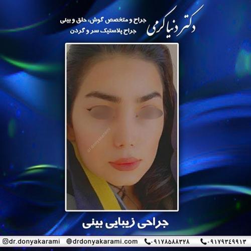 جراحی-بینی-60