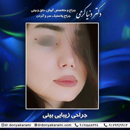 جراحی-بینی-61