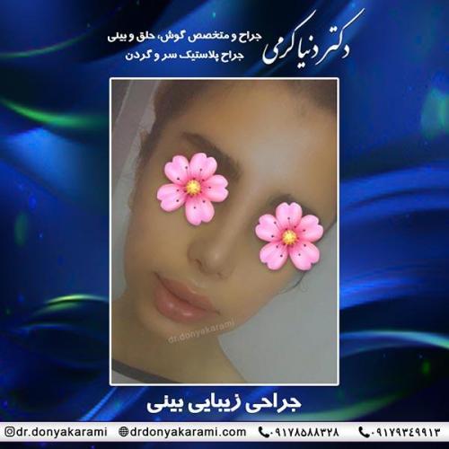 جراحی-بینی-63