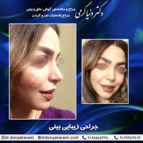 جراحی-بینی-65
