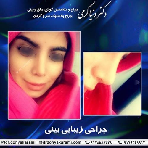جراحی-بینی-66