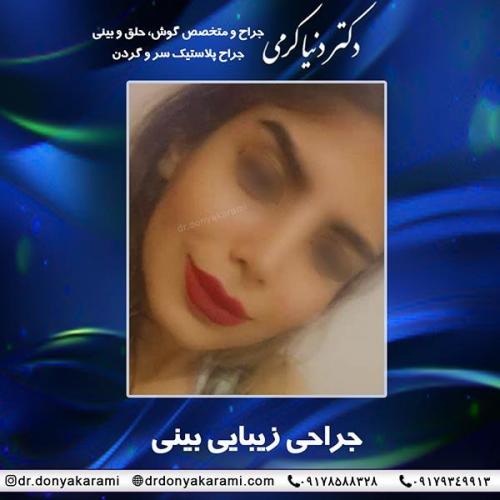 جراحی-بینی-67