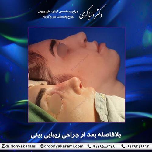 جراحی-بینی-68