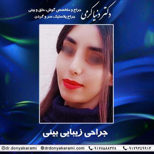 جراحی-بینی-69