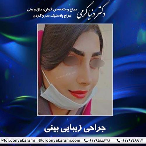 جراحی-بینی-70