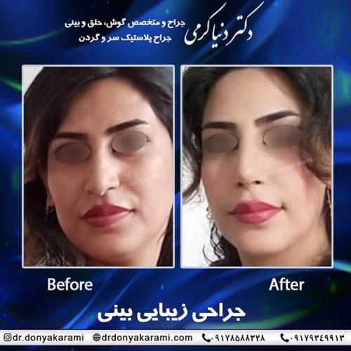 جراحی-بینی-73