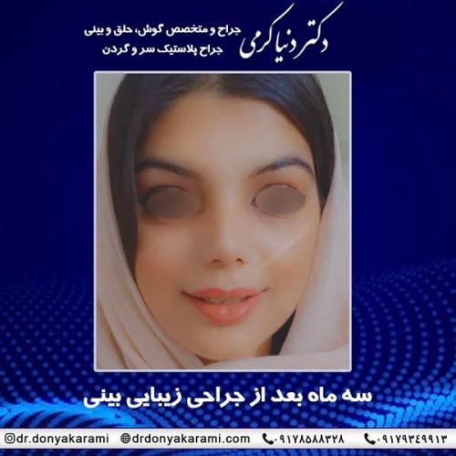 جراحی-بینی-74