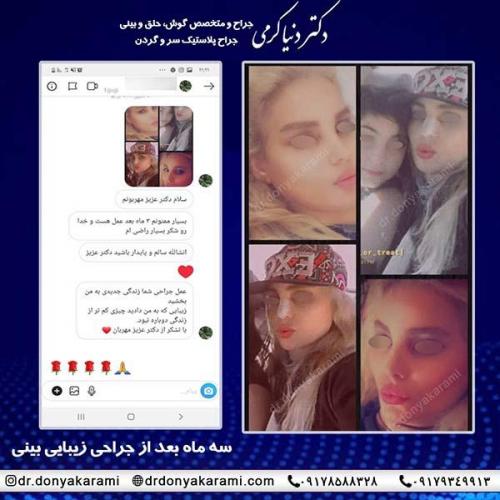 جراحی-بینی-75