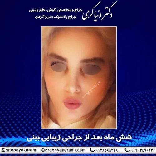 جراحی-بینی-77