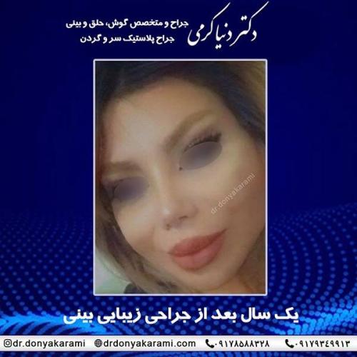 جراحی-بینی-78