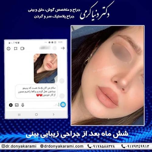 جراحی-بینی-79