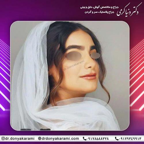 جراحی-بینی-8