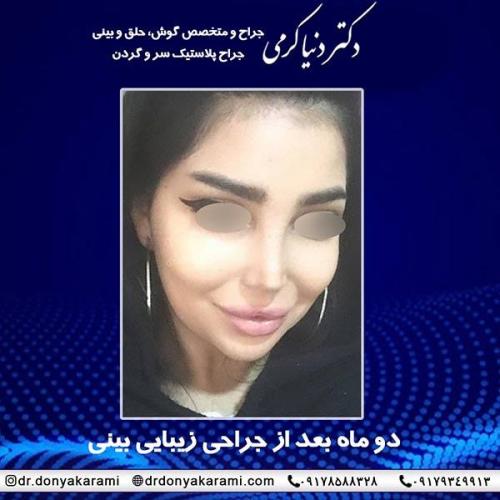 جراحی-بینی-81