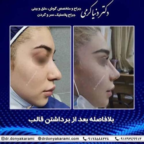 جراحی-بینی-85