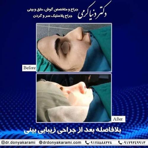 جراحی-بینی-89