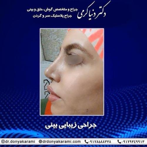 جراحی-بینی-91