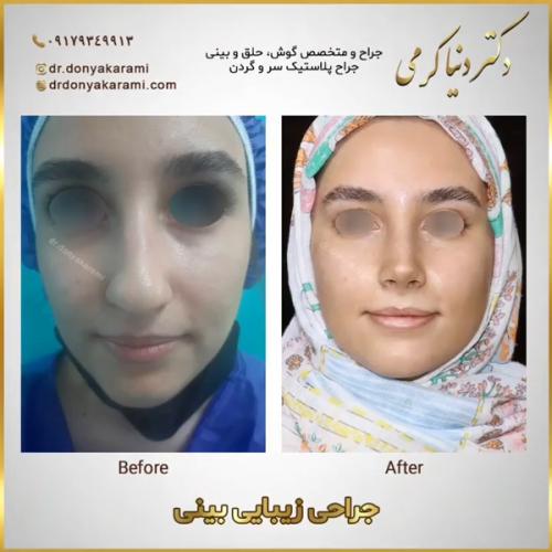 جراحی-بینی154