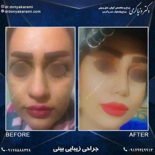 جراحی بینی 92 (2)