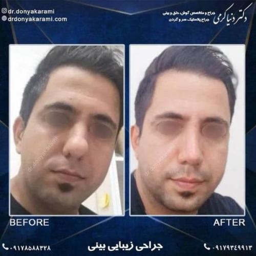 جراحی بینی 92 (4)