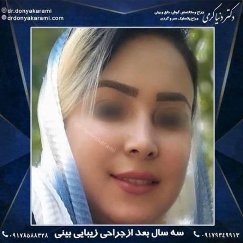 جراحی بینی 92 (5)