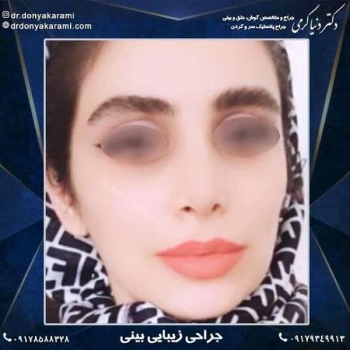 جراحی بینی 92 (7)